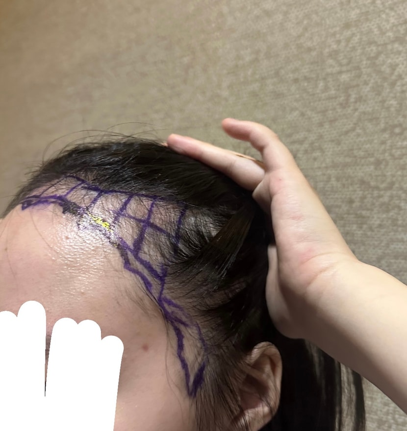수술 전