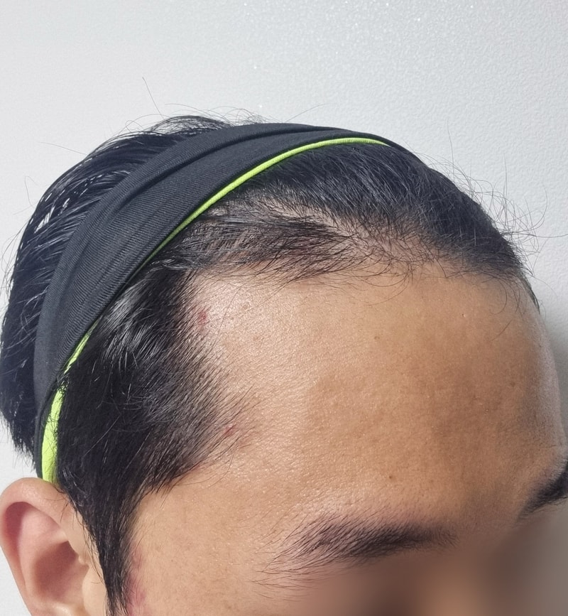 권범준_모발_240621_수술전_3.jpg
