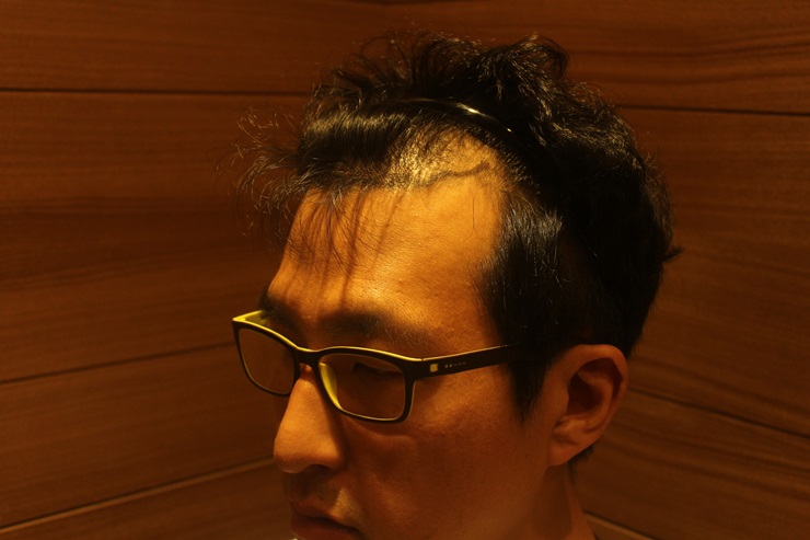 모발이식비용 (1).JPG