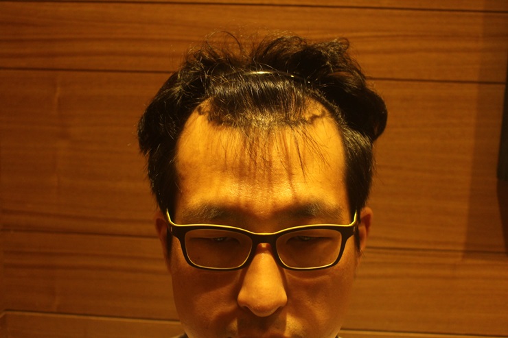 모발이식비용 (3).JPG