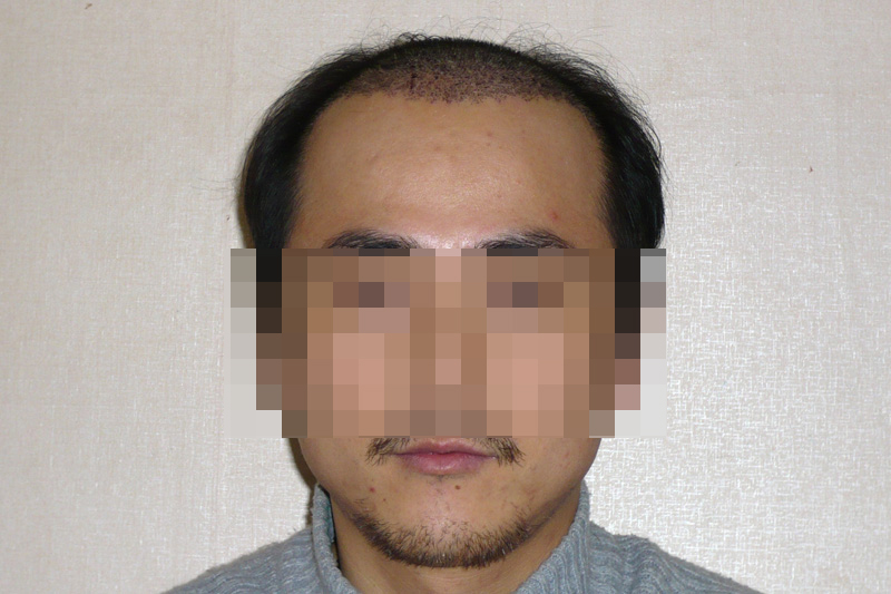 03수술후8일.jpg
