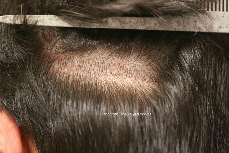 뒤통수scar 위에 hair.jpg