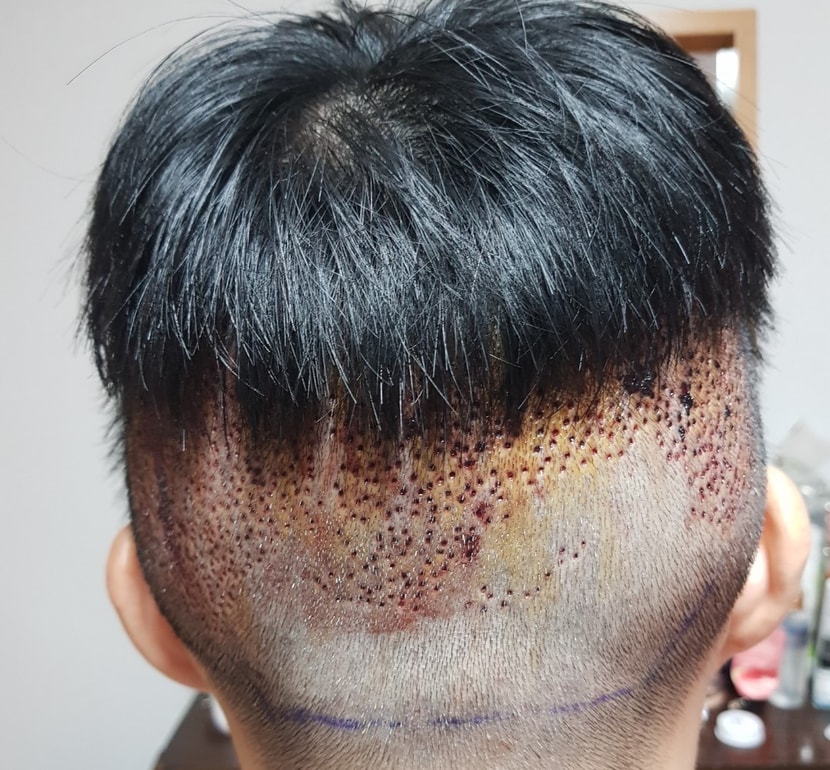 비절개_채취부위