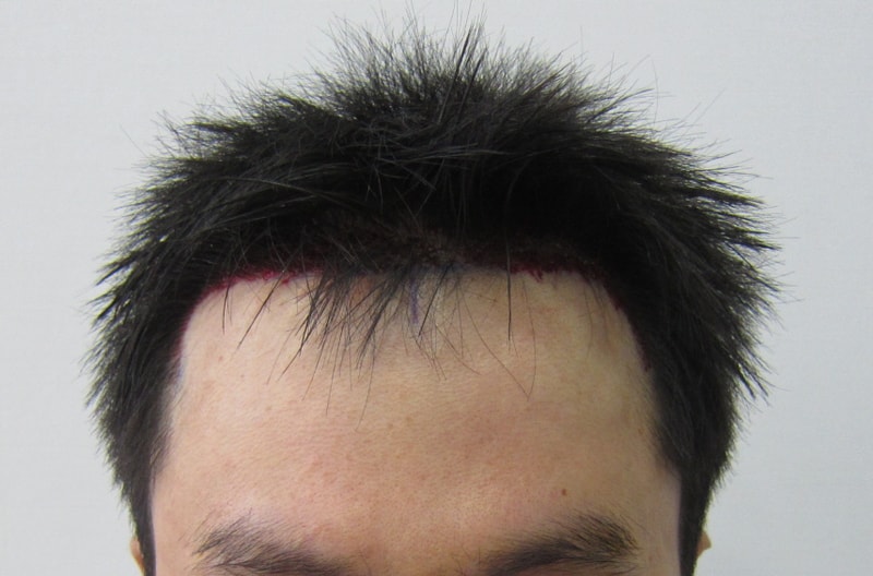 수술후1.JPG