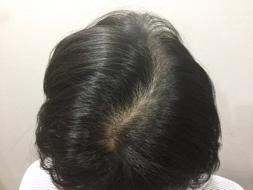 수술 진행할 가르마 및 정수리