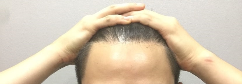 수술 전 앞 헤어라인