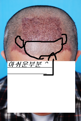 수술후.bmp