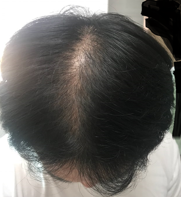 수술 전.png