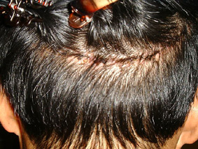 full-scar.jpg