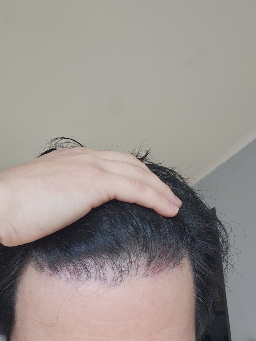 수술 13개월