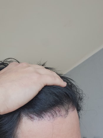 수술 13개월