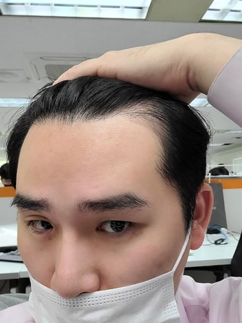 수술 2년후 좌