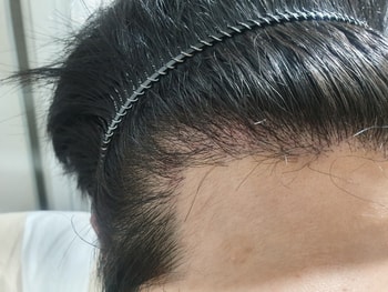 현재(재수술 1개월차)