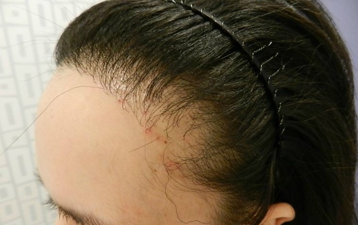 수술 후 비어있던 머리, 염증생김