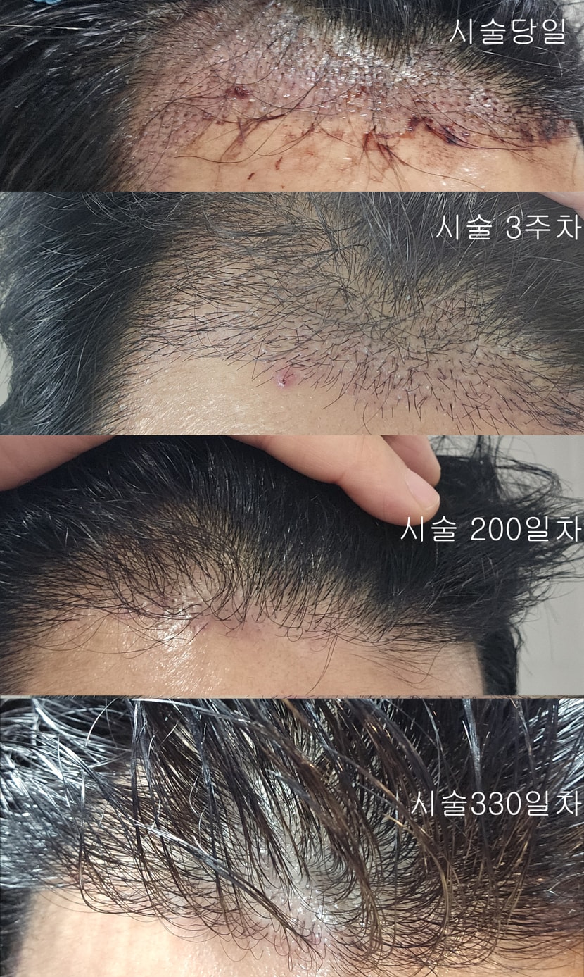 모발이식기록