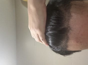 3일차 경과사진