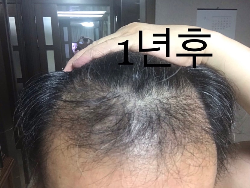 1년후