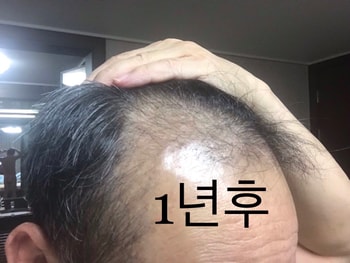 1년후