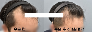 수술 후 6개월