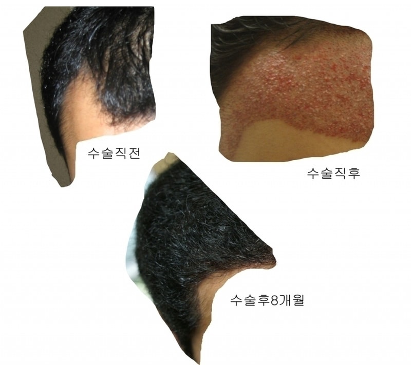 알마니 8개월 후기 및 주저리...