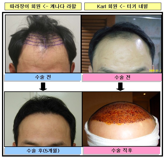 터키 수술후기(수술직후)