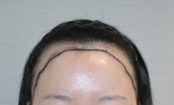 수술 전