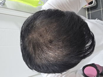 수술후
