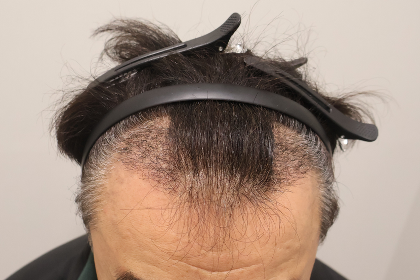 수술후