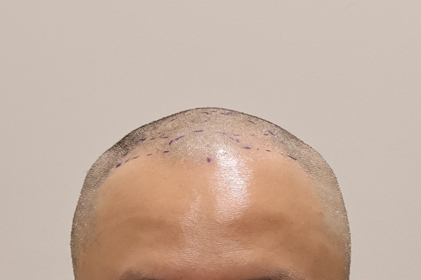 수술전