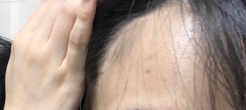 꽉찬 헤어라인 (좌)