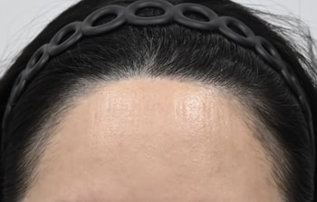 수술 전 사진 