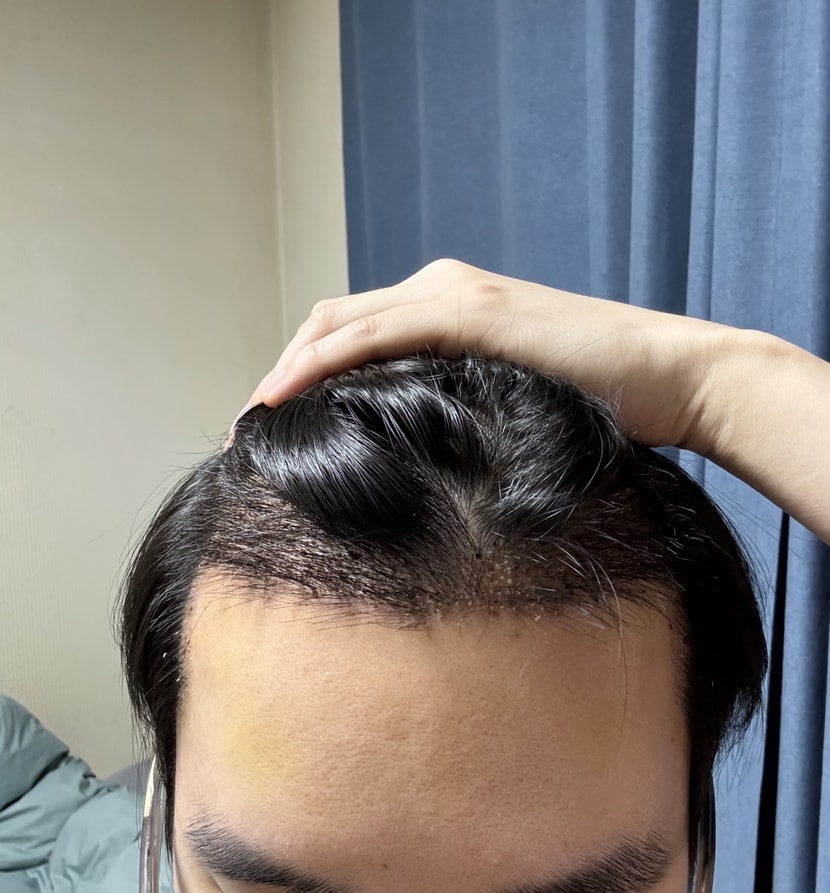 수술후
