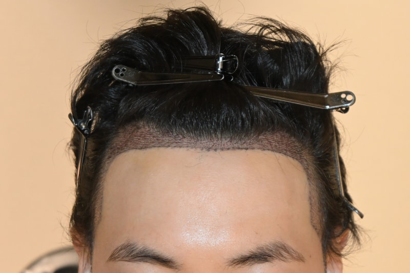 수술 3.jpg