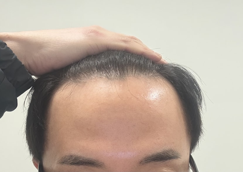 수술 전