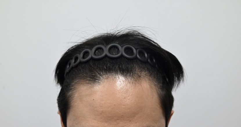 수술 전