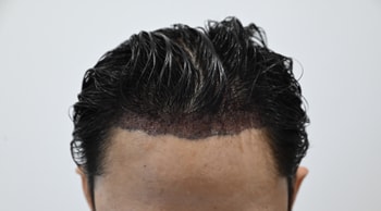 수술 후