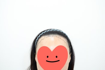 시술전 정면