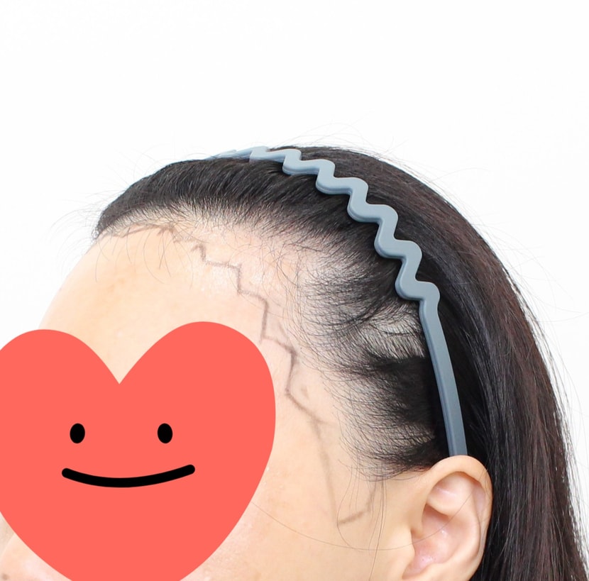 시술전 옆면