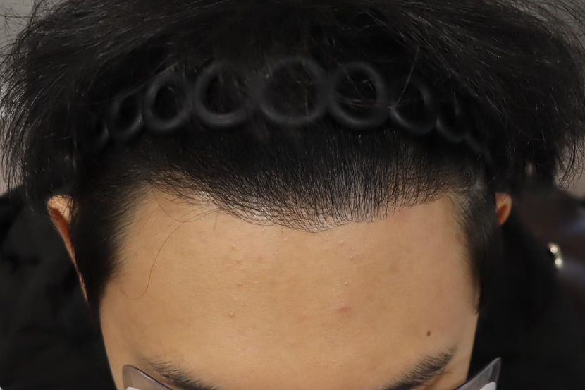 수술후