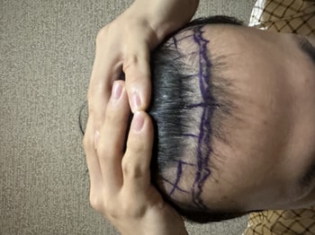 이식 전
