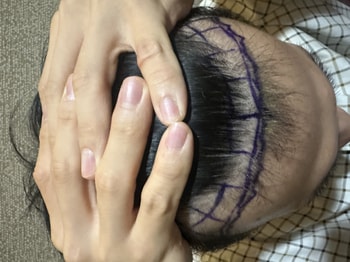 이식 전