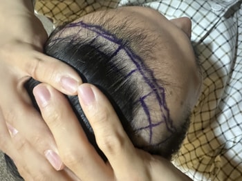 이식 전