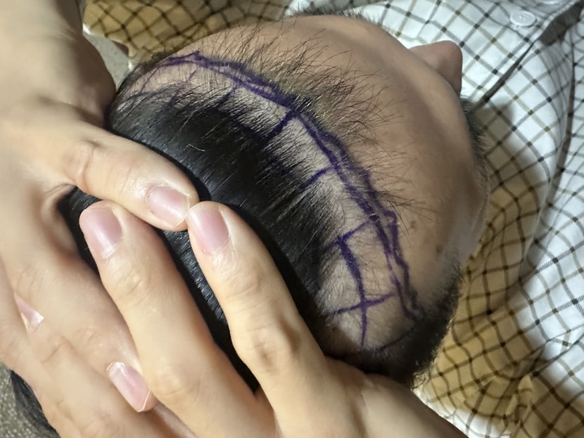 이식 전 