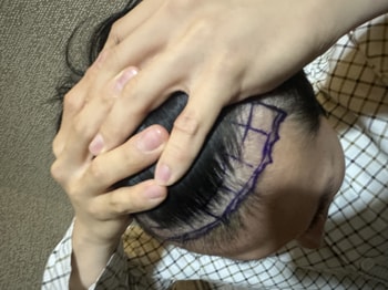 이식 전