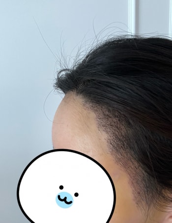 수술7일차
