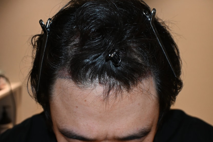 수술후 다음날