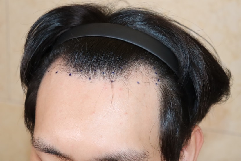 수술 전 사진입니다