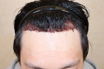 수술 후 사진입니다