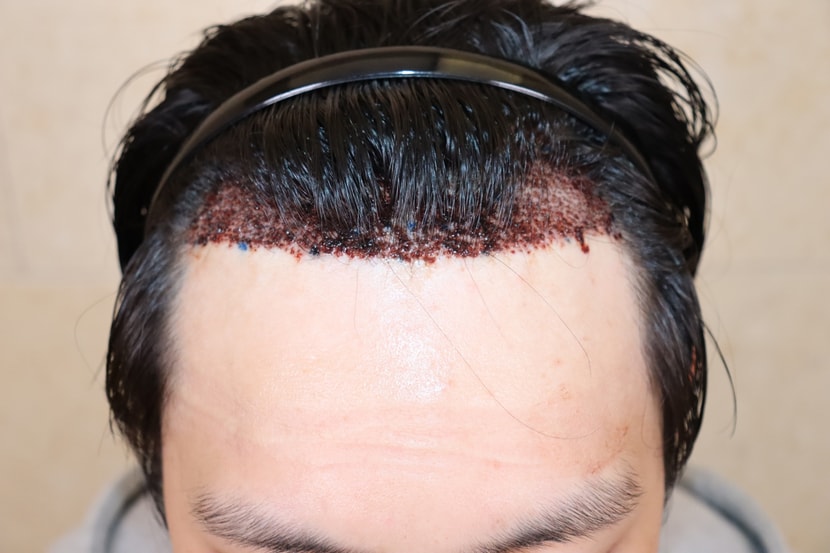 수술 후 사진입니다