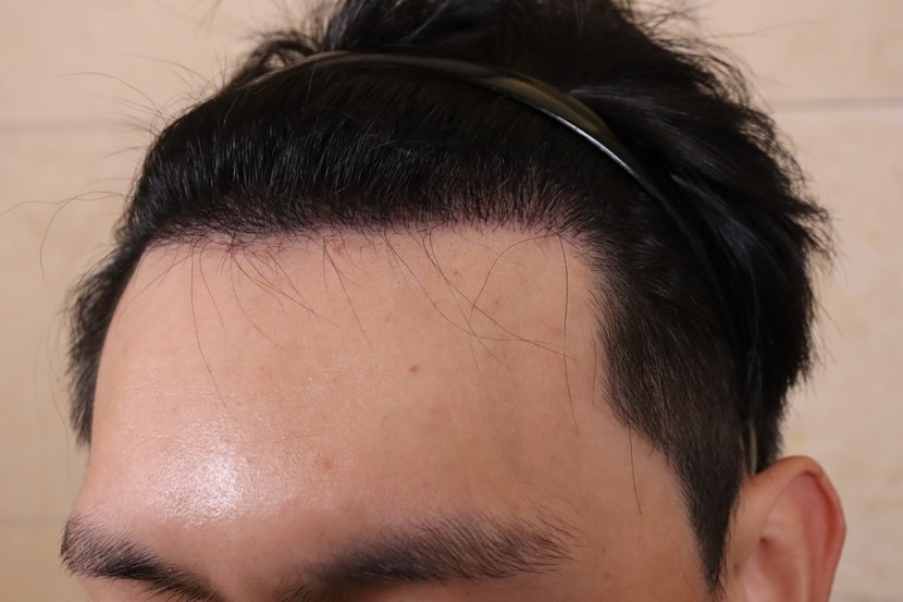 현재 8개월 후 사진입니다